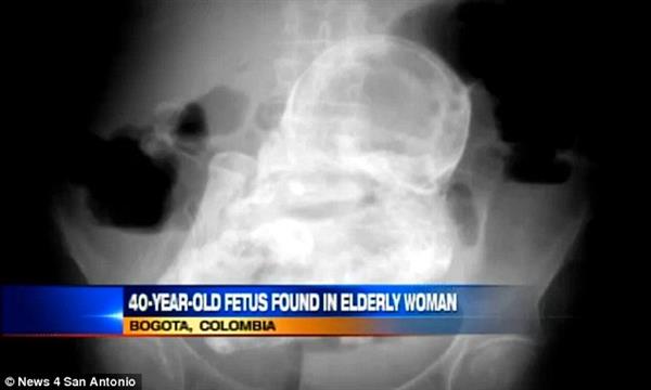 40-year-old Unborn Child Inside 82 Year-old Woman